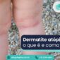 Alergologica - Blog - Dermatite Atopica