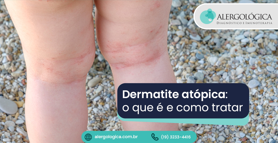 Alergologica - Blog - Dermatite Atopica