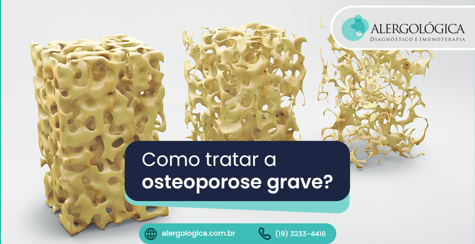 Alergologica - Blog_Osteoporose grave como tratar