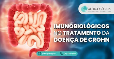 Alergologica - Imunobiológicos no tratamento da doença de Crohn